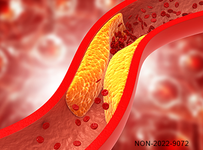 Diabete e rischio cardiovascolare